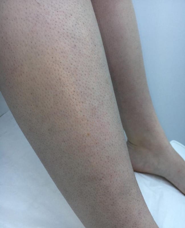 After: Legs