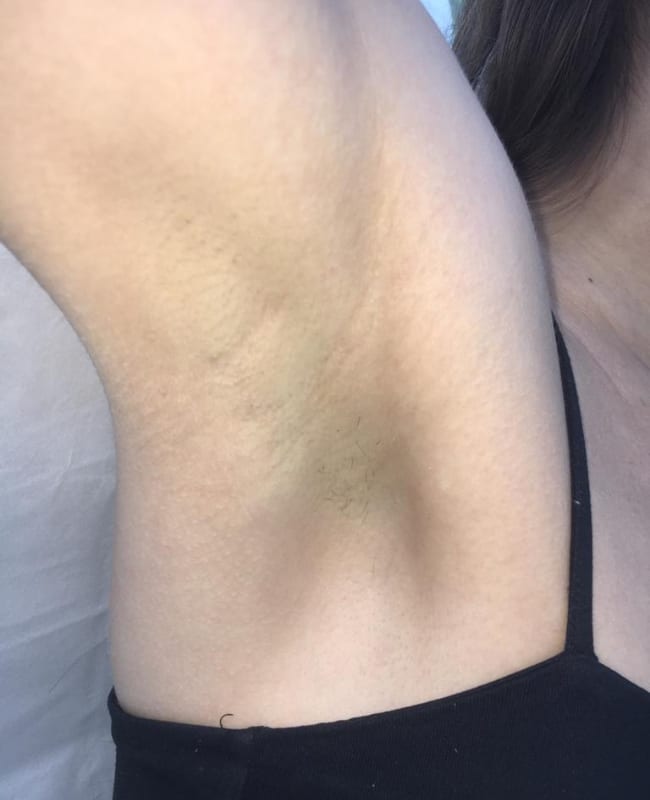 After: Underarms