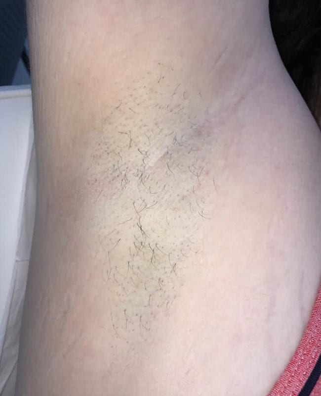 After: Underarms