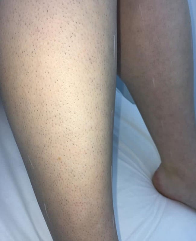 Before: Legs