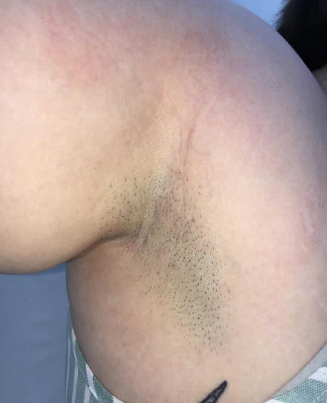 Before: Underarms