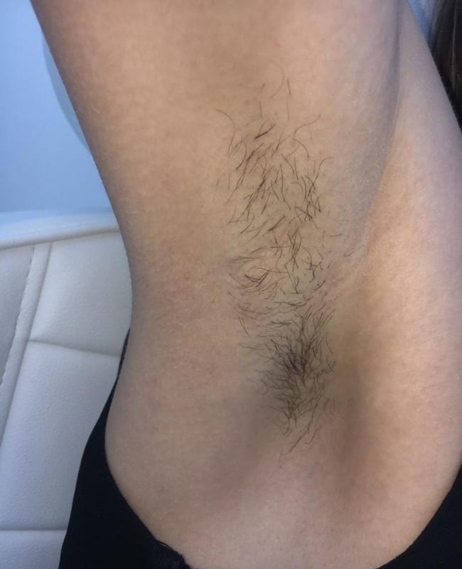 Before: Underarms